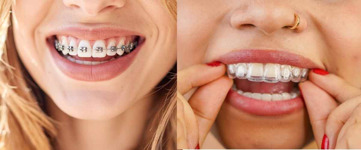 Types of Braces Types of Braces
