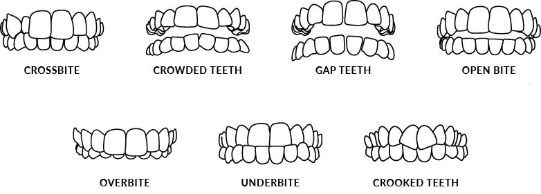 Invisalign cost in the 5 biggest destinations - Dentakay