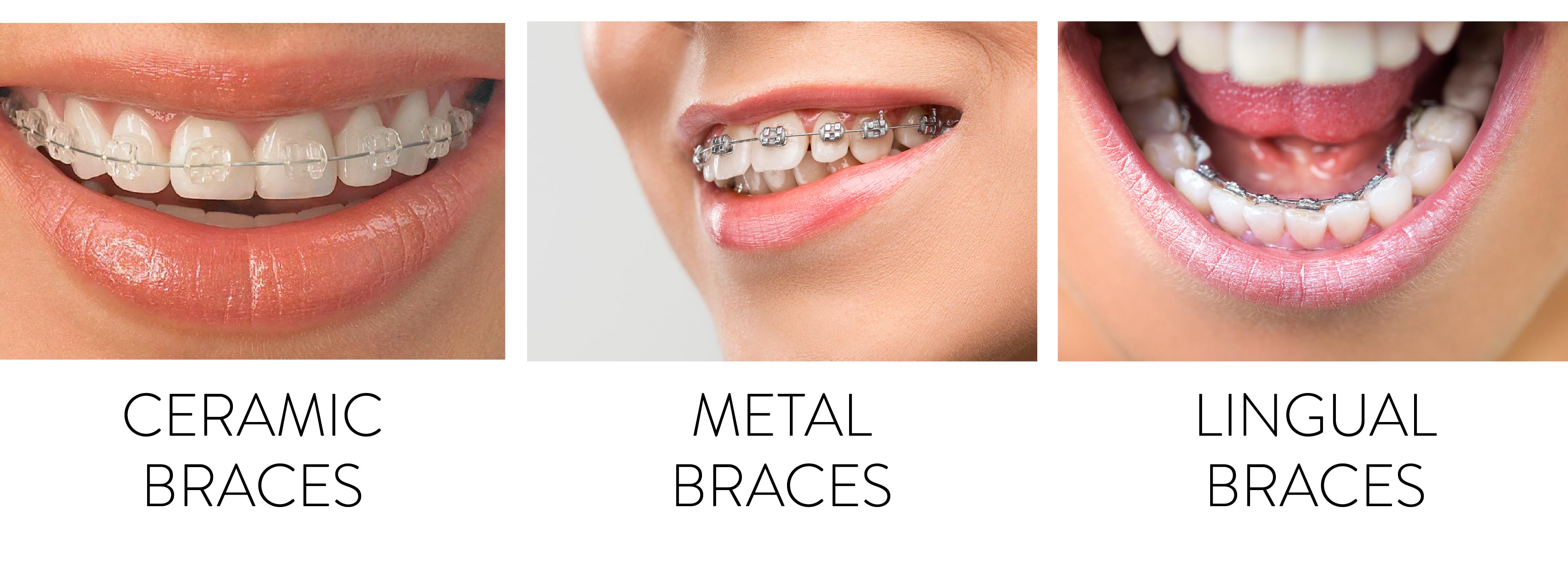 Metal braces: Uses, costs, benefits, and more